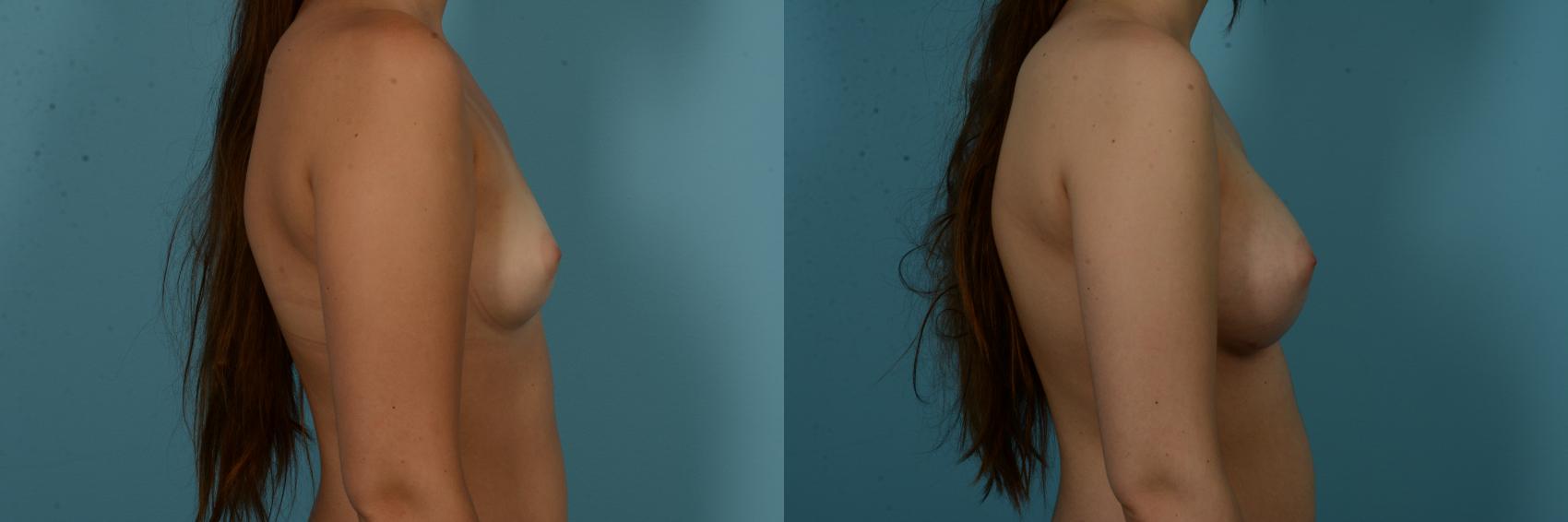 Before & After Breast Augmentation by Dr. Sinno Case 1132 Right Side View in Chicago, IL