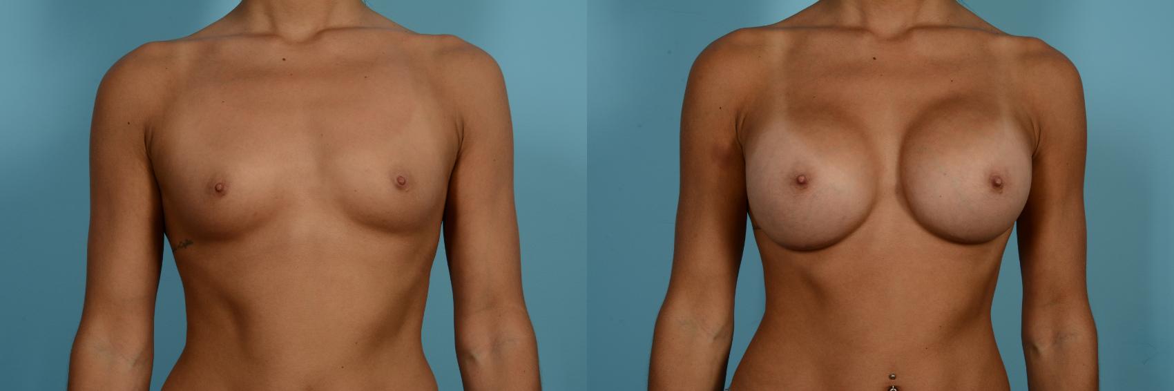 Dr. Sinno Breast Augmentation in Chicago, Illinois