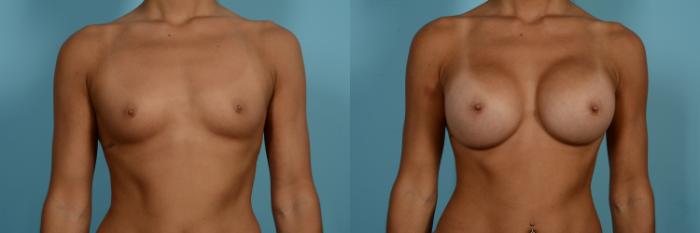 Dr. Sinno Breast Augmentation in Chicago, Illinois