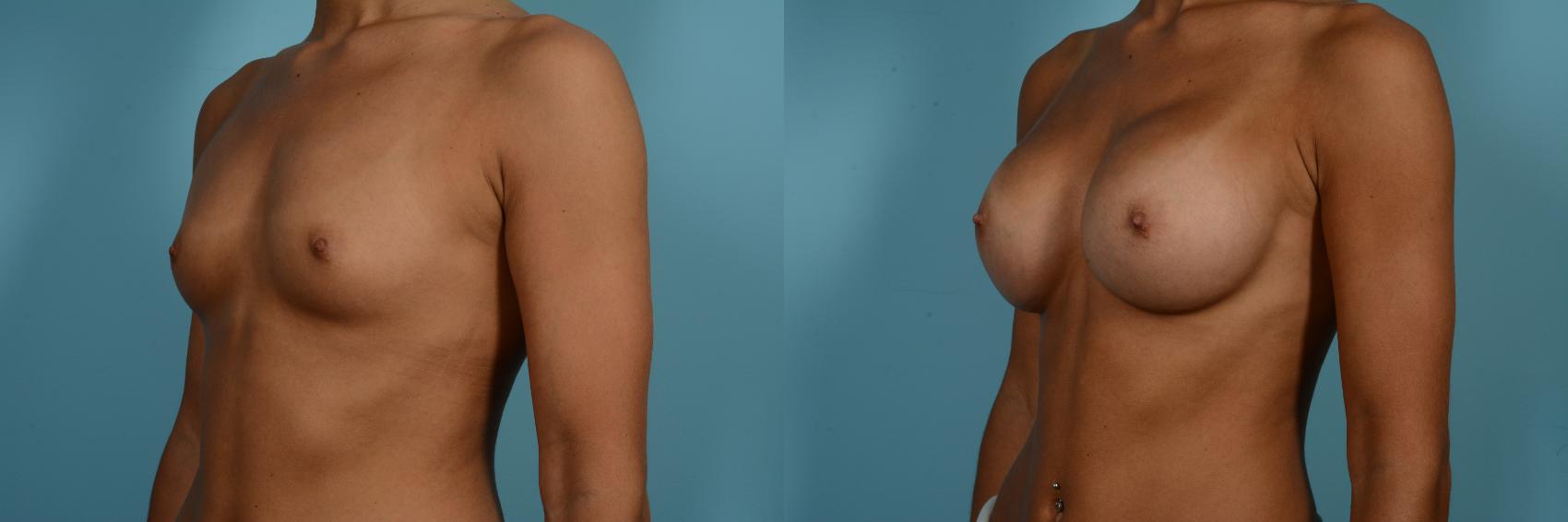 Dr. Sinno Breast Augmentation in Chicago, Illinois
