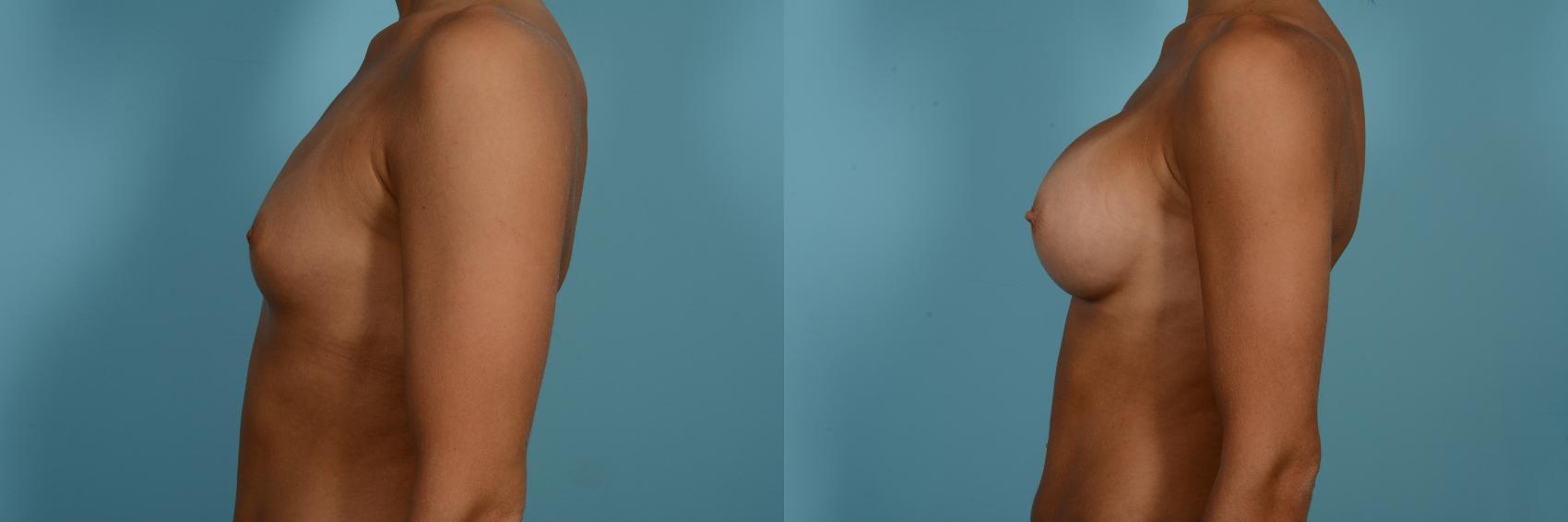 Dr. Sinno Breast Augmentation in Chicago, Illinois