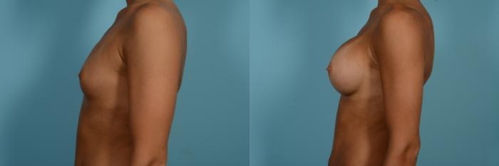 Dr. Sinno Breast Augmentation in Chicago, Illinois