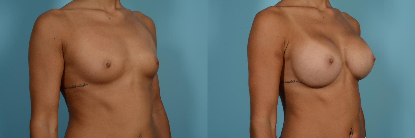 Dr. Sinno Breast Augmentation in Chicago, Illinois