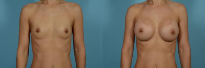 Dr. Sinno Breast Augmentation in Chicago, Illinois