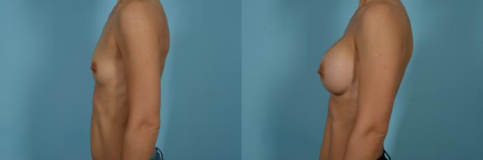 Dr. Sinno Breast Augmentation in Chicago, Illinois