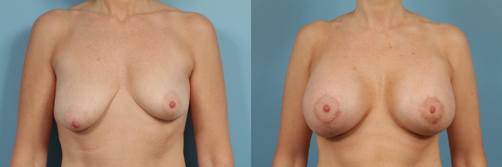 Before & After Breast Augmentation With Lift Case 133 View #1 View in Chicago, IL