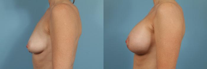 Before & After Breast Augmentation With Lift Case 133 View #2 View in Chicago, IL
