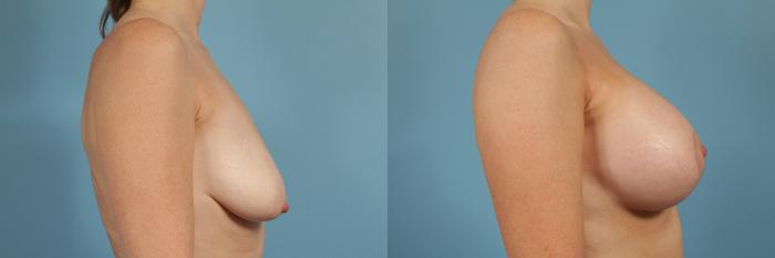 Before & After Breast Augmentation With Lift Case 133 View #3 View in Chicago, IL