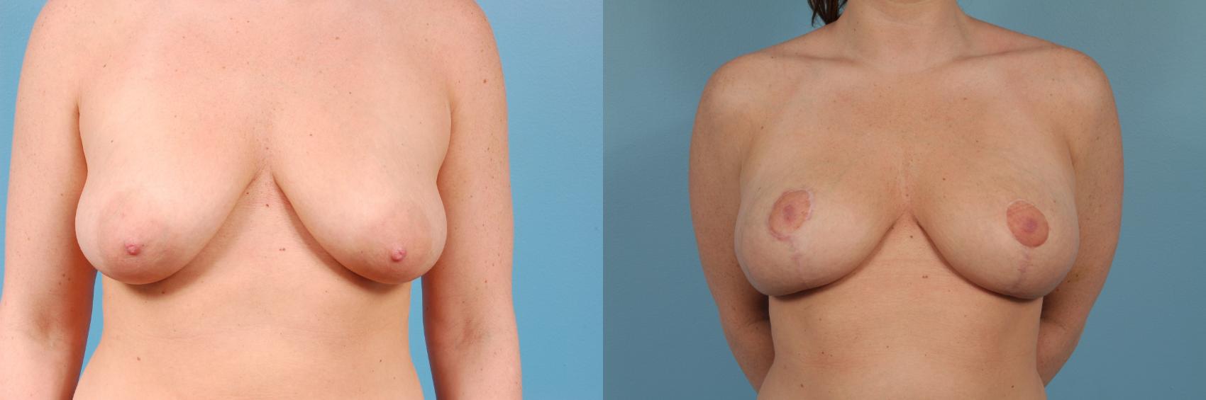 Before & After Breast Augmentation With Lift Case 160 View #1 View in Chicago, IL