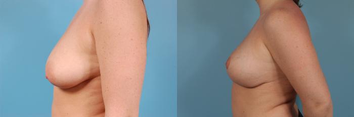 Before & After Breast Augmentation With Lift Case 160 View #2 View in Chicago, IL