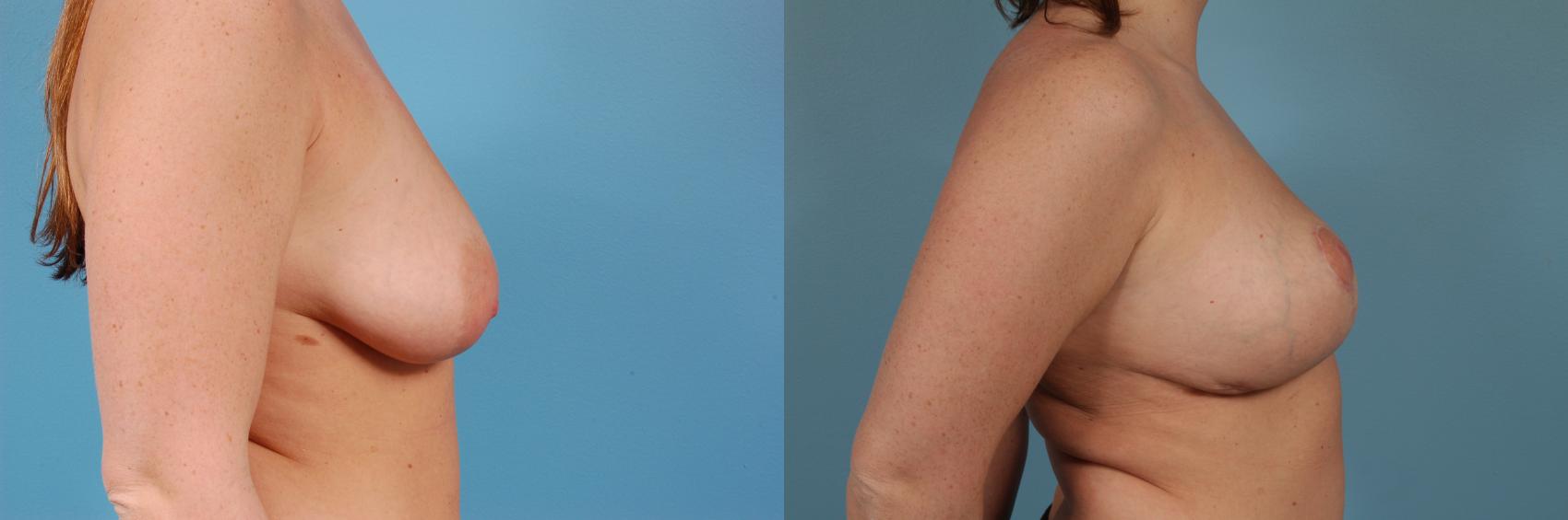 Before & After Breast Augmentation With Lift Case 160 View #3 View in Chicago, IL