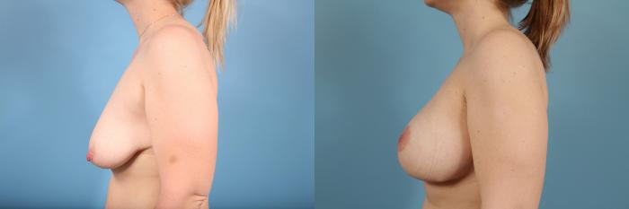 Before & After Breast Augmentation With Lift Case 162 View #2 View in Chicago, IL
