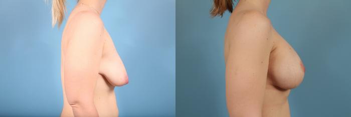 Before & After Breast Augmentation With Lift Case 162 View #3 View in Chicago, IL