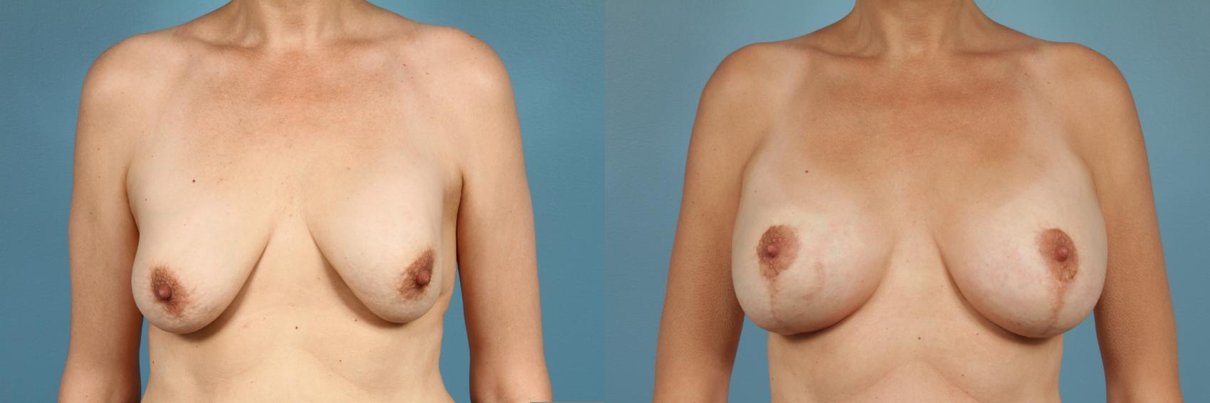 Before & After Breast Augmentation With Lift Case 167 View #1 View in Chicago, IL