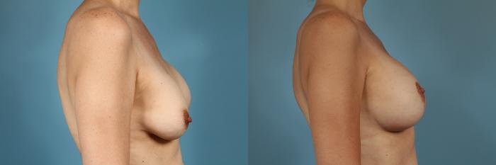 Before & After Breast Augmentation With Lift Case 167 View #3 View in Chicago, IL
