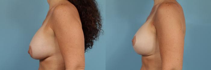 Before & After Breast Augmentation With Lift Case 172 View #2 View in Chicago, IL