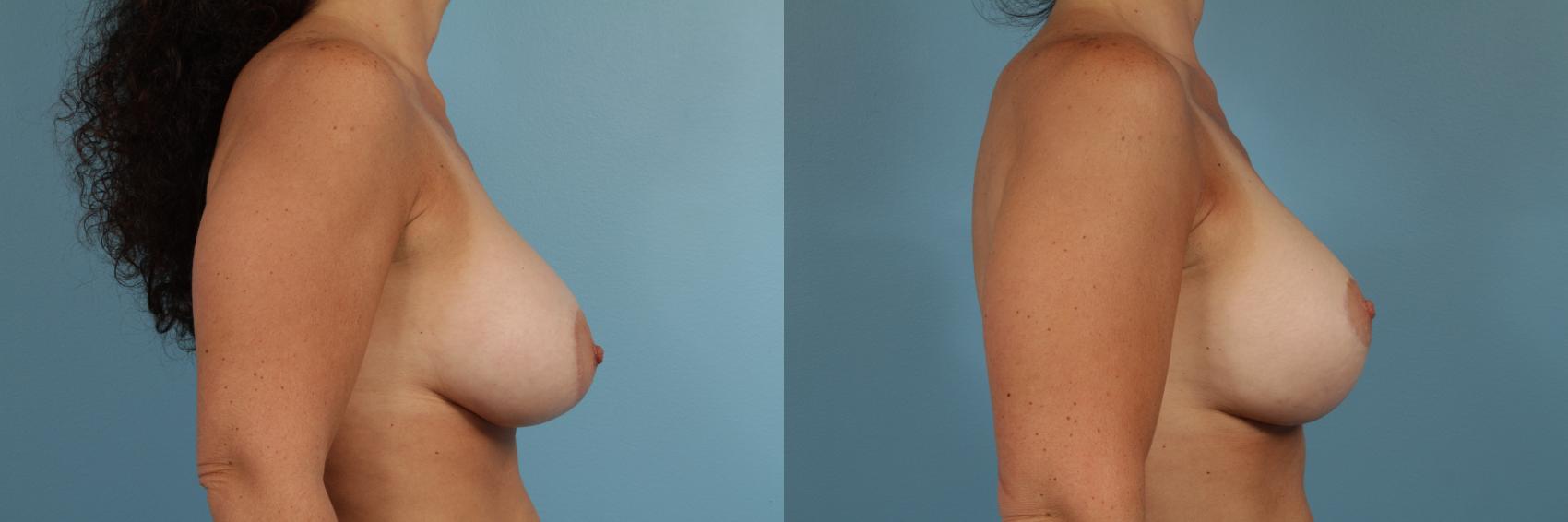 Before & After Breast Augmentation With Lift Case 172 View #3 View in Chicago, IL