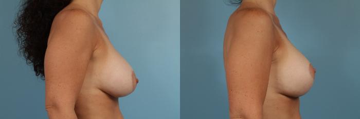 Before & After Breast Augmentation With Lift Case 172 View #3 View in Chicago, IL