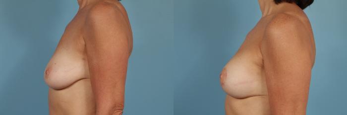 Before & After Breast Augmentation With Lift Case 202 View #2 View in Chicago, IL
