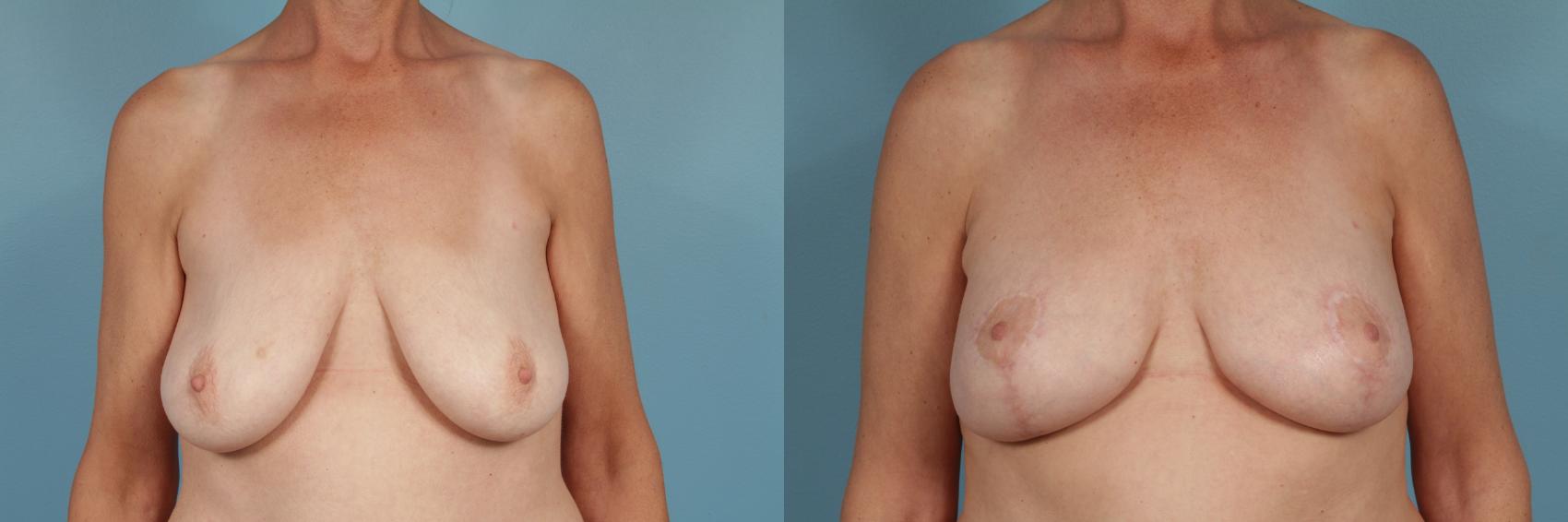 Before & After Breast Augmentation With Lift Case 244 View #1 View in Chicago, IL