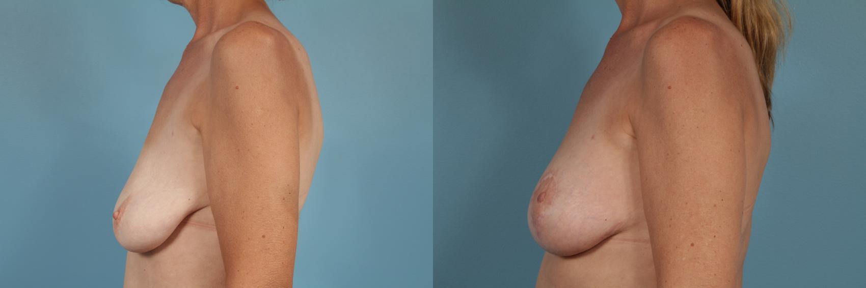 Before & After Breast Augmentation With Lift Case 244 View #2 View in Chicago, IL