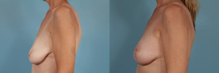 Before & After Breast Augmentation With Lift Case 244 View #2 View in Chicago, IL
