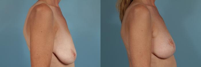 Before & After Breast Augmentation With Lift Case 244 View #3 View in Chicago, IL