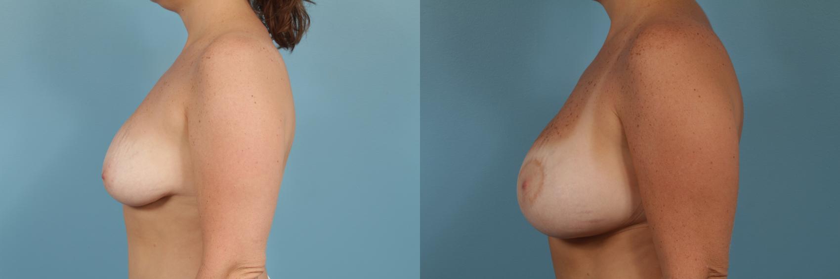Before & After Breast Augmentation With Lift Case 252 View #2 View in Chicago, IL