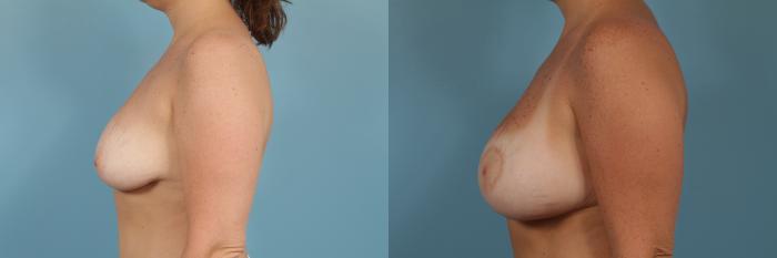 Before & After Breast Augmentation With Lift Case 252 View #2 View in Chicago, IL