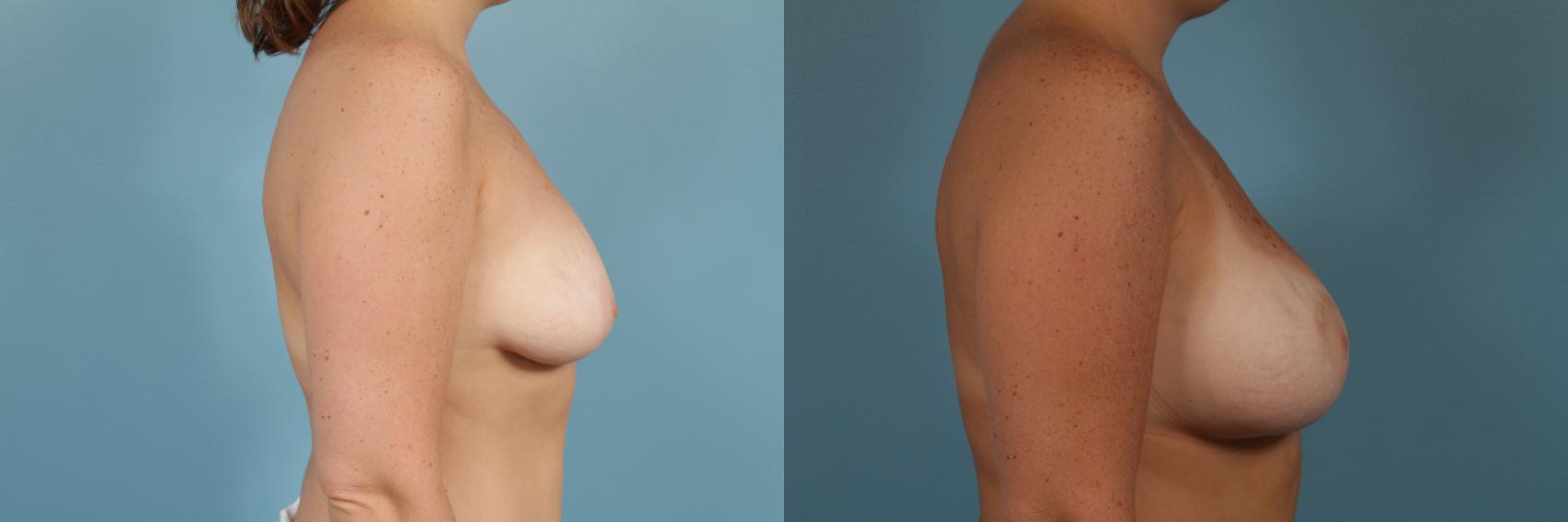 Before & After Breast Augmentation With Lift Case 252 View #3 View in Chicago, IL