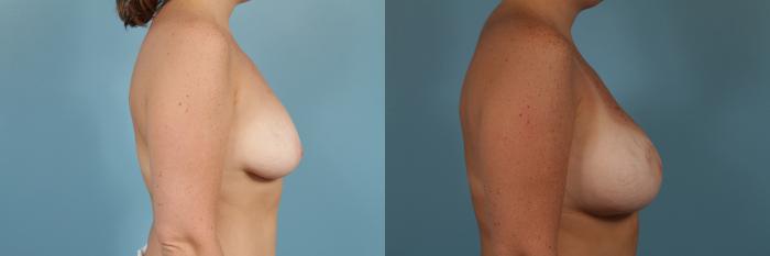 Before & After Breast Augmentation With Lift Case 252 View #3 View in Chicago, IL