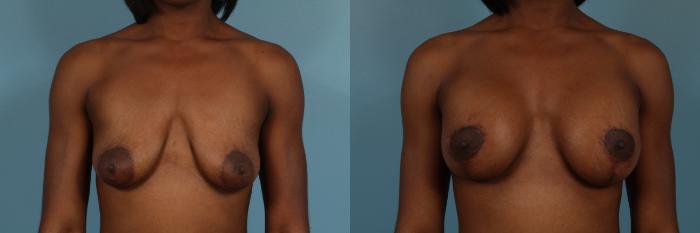 Before & After Breast Augmentation With Lift Case 253 View #1 View in Chicago, IL