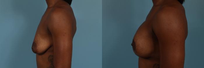 Before & After Breast Augmentation With Lift Case 253 View #2 View in Chicago, IL