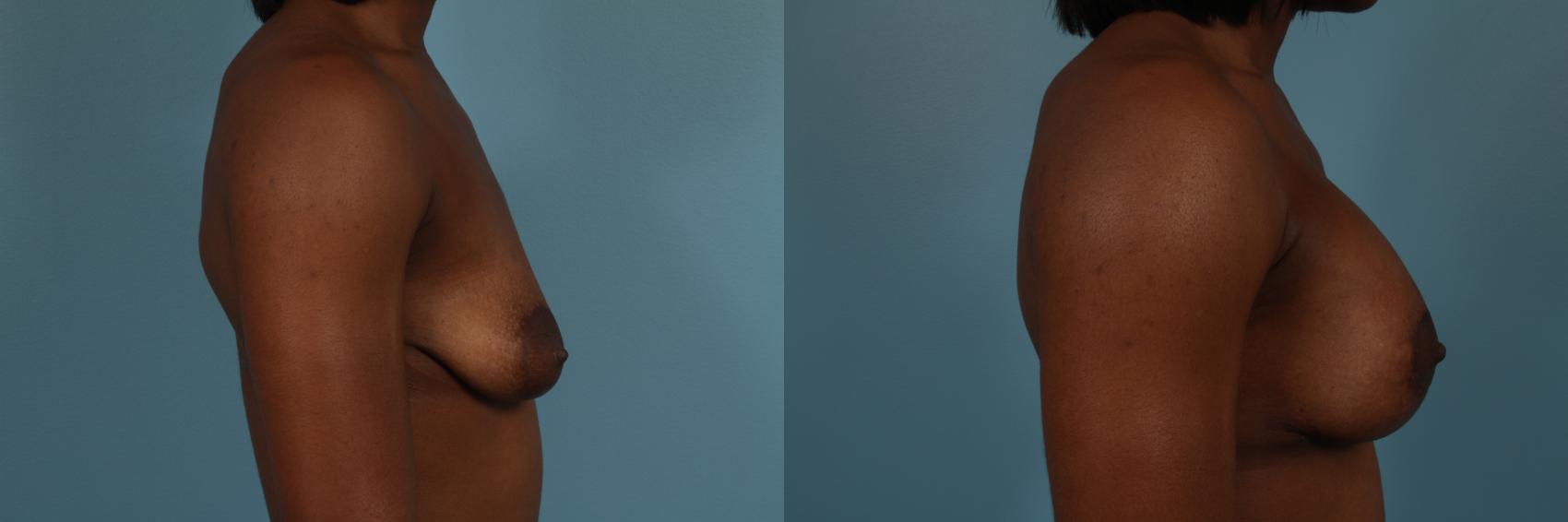 Before & After Breast Augmentation With Lift Case 253 View #3 View in Chicago, IL