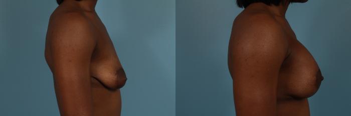 Before & After Breast Augmentation With Lift Case 253 View #3 View in Chicago, IL