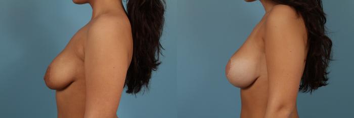 Before & After Breast Augmentation With Lift Case 256 View #2 View in Chicago, IL