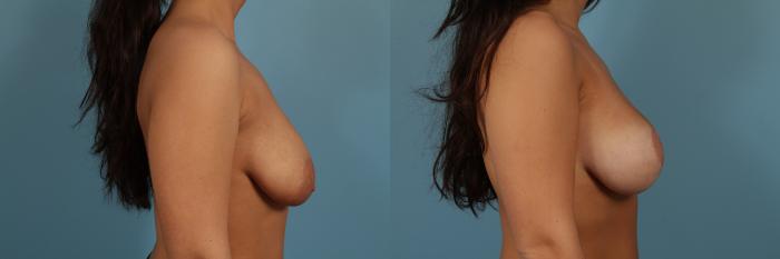 Before & After Breast Augmentation With Lift Case 256 View #3 View in Chicago, IL
