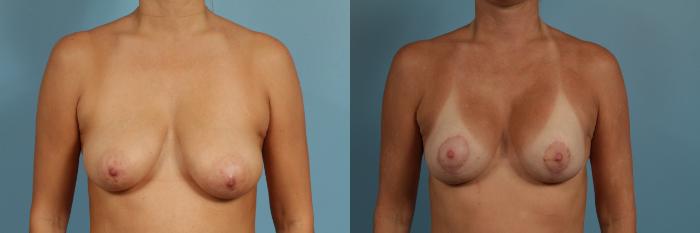 Before & After Breast Augmentation With Lift Case 278 View #1 View in Chicago, IL