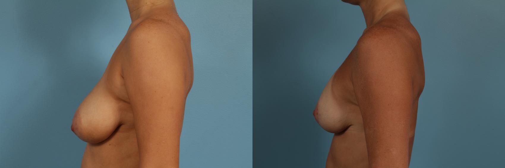Before & After Breast Augmentation With Lift Case 278 View #2 View in Chicago, IL