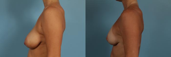 Before & After Breast Augmentation With Lift Case 278 View #2 View in Chicago, IL