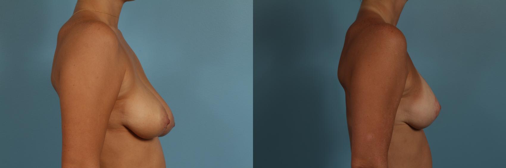 Before & After Breast Augmentation With Lift Case 278 View #3 View in Chicago, IL