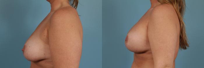 Before & After Breast Augmentation With Lift Case 288 View #2 View in Chicago, IL