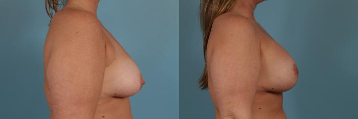 Before & After Breast Augmentation With Lift Case 288 View #3 View in Chicago, IL