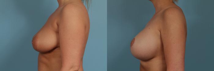 Before & After Breast Augmentation With Lift Case 306 View #2 View in Chicago, IL
