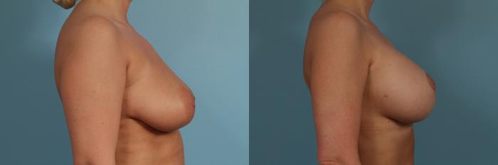 Before & After Breast Augmentation With Lift Case 306 View #3 View in Chicago, IL
