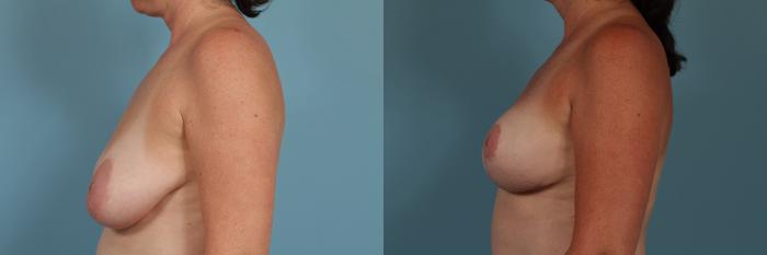 Before & After Breast Augmentation With Lift Case 307 View #2 View in Chicago, IL
