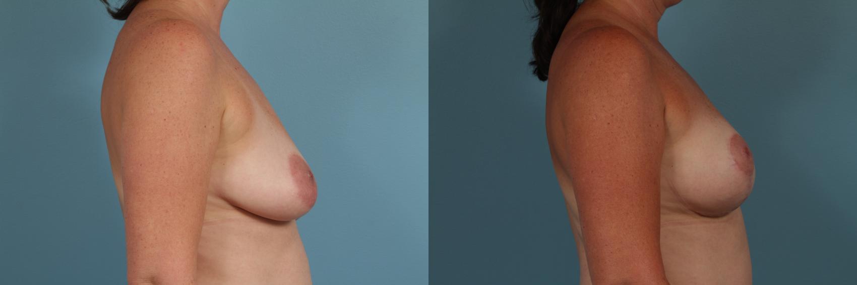 Before & After Breast Augmentation With Lift Case 307 View #3 View in Chicago, IL