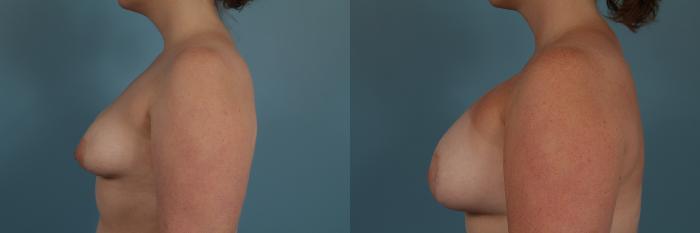 Before & After Breast Augmentation With Lift Case 308 View #2 View in Chicago, IL