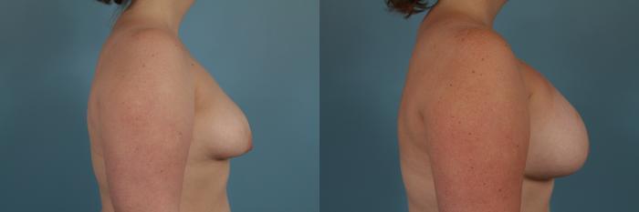Before & After Breast Augmentation With Lift Case 308 View #3 View in Chicago, IL