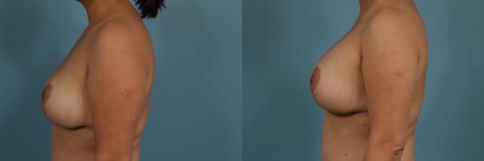 Before & After Breast Augmentation With Lift Case 312 View #2 View in Chicago, IL